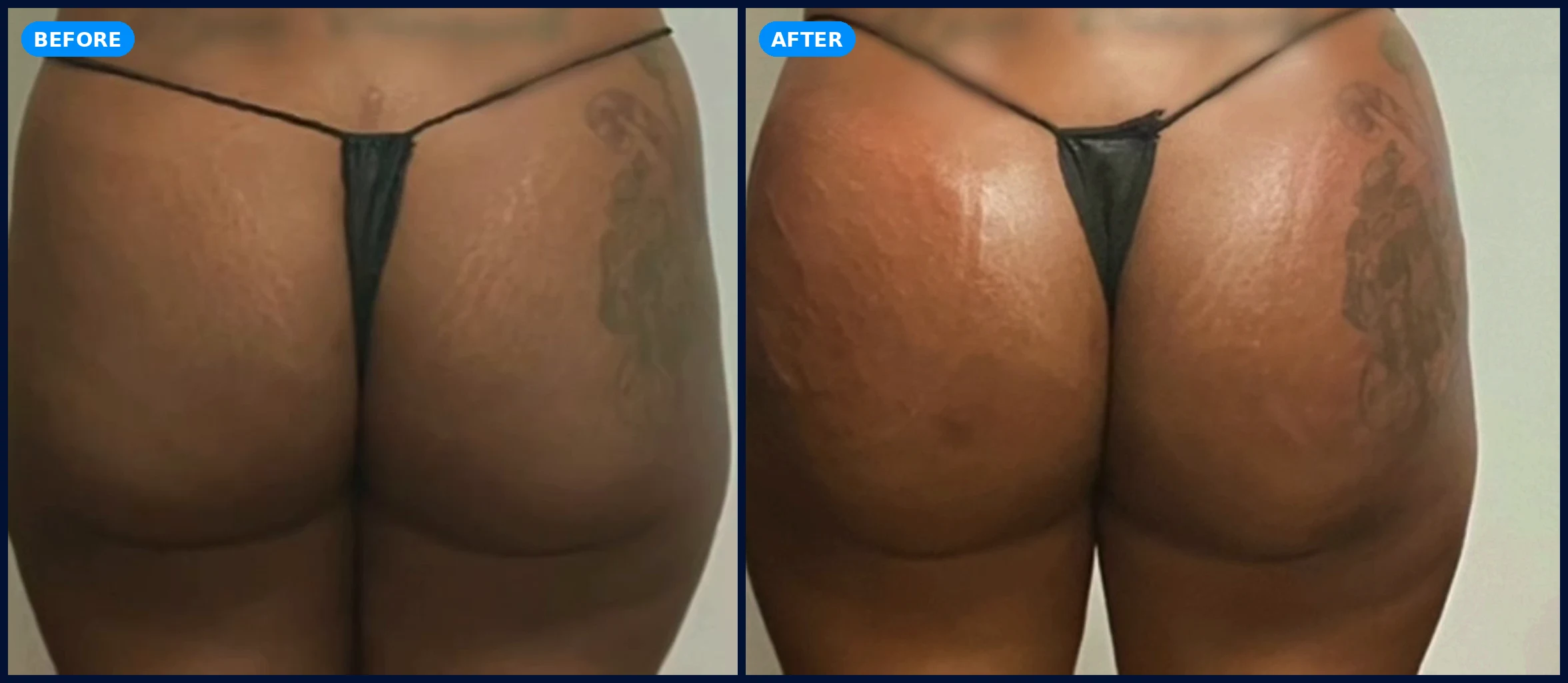 Booty Lift, 8 sessions before and after