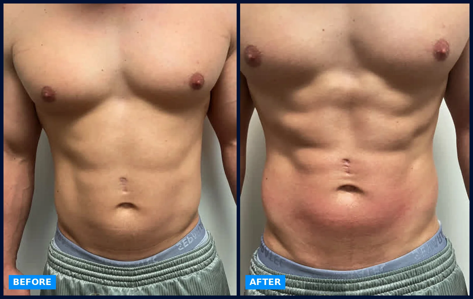 Core, 4 sessions + G5 + cavitation before and after