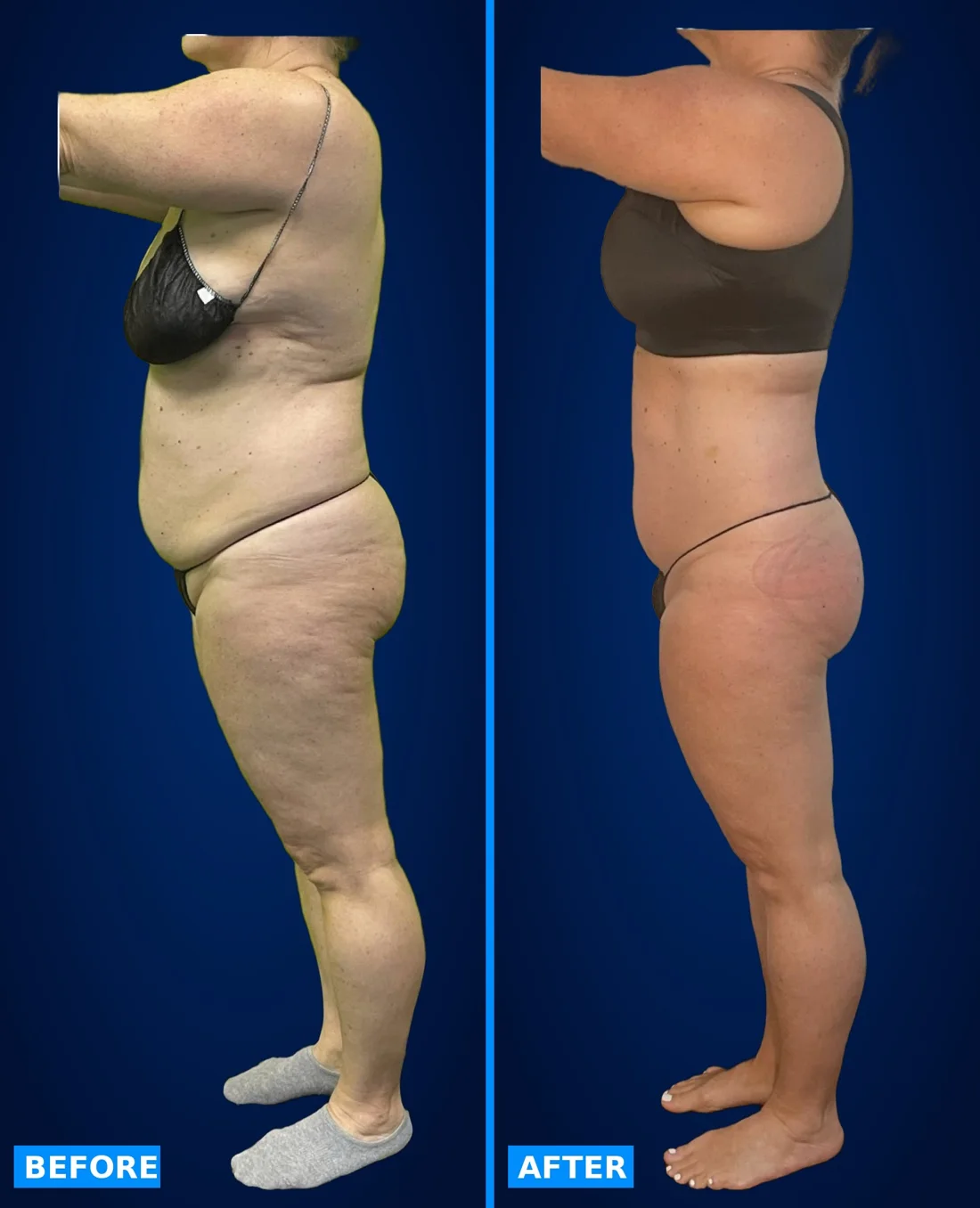 Before and after: side profile, belly and booty